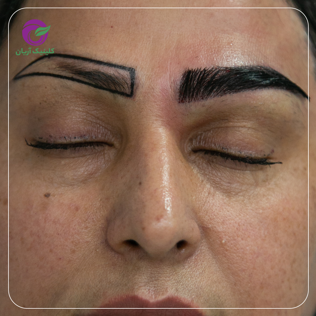 گالری فیلم کاشت ابرو